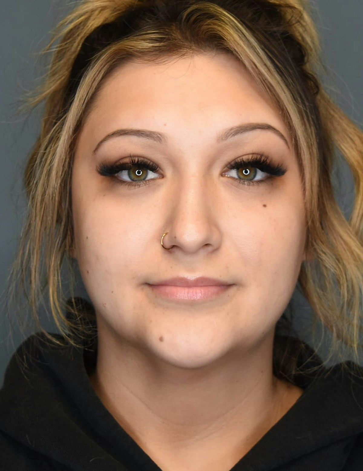 Liposuction Before & After Gallery - Patient 303405 - Image 11