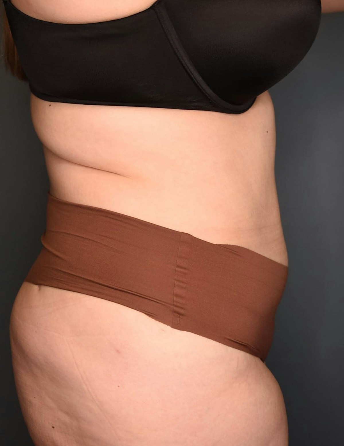 Tummy Tuck Before & After Gallery - Patient 212891 - Image 6