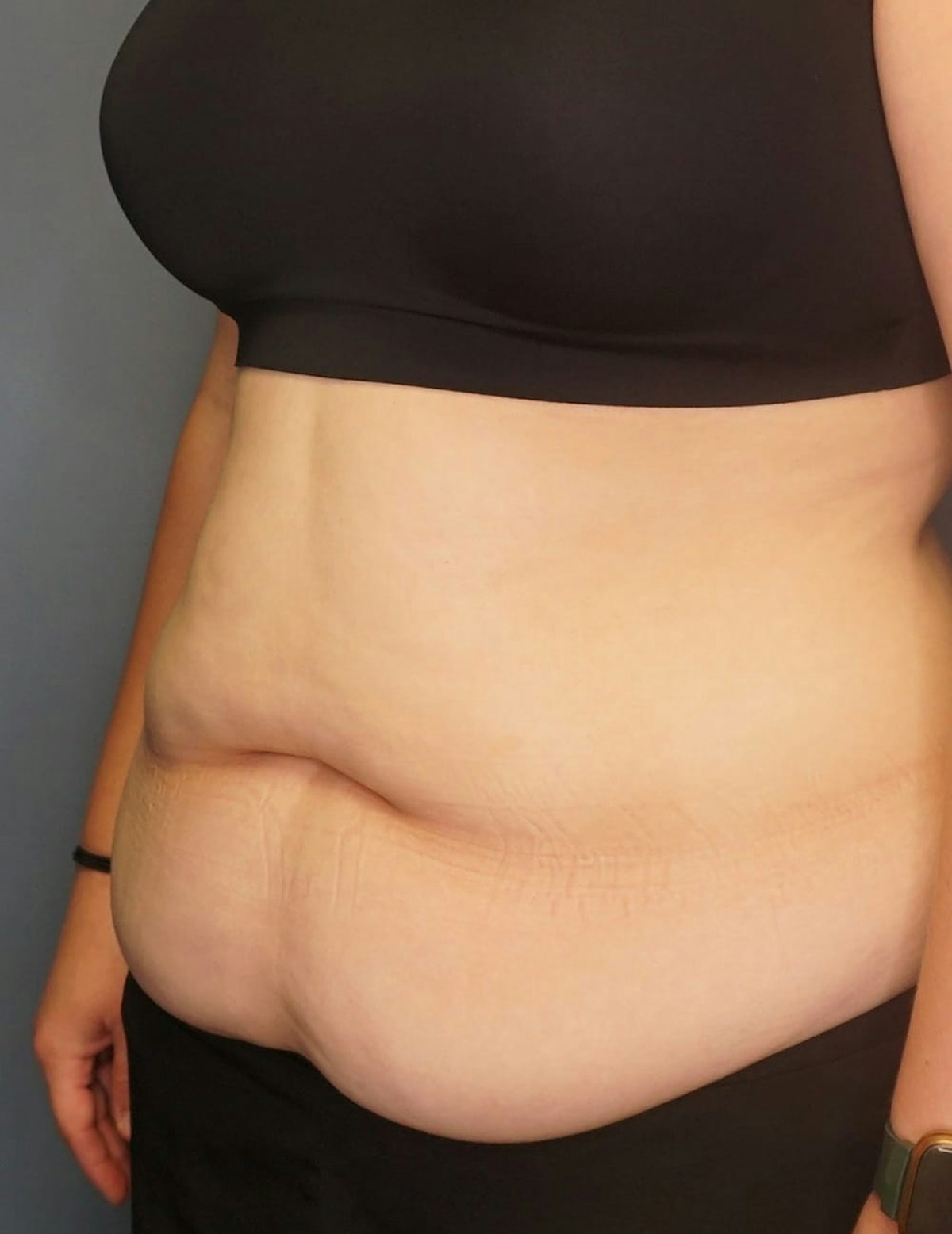 Tummy Tuck Before & After Gallery - Patient 212891 - Image 9