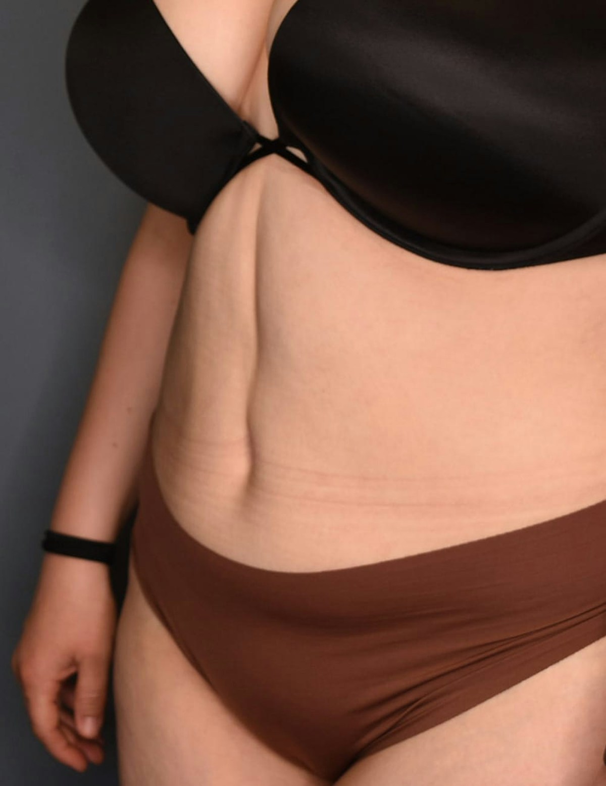 Tummy Tuck Before & After Gallery - Patient 212891 - Image 10