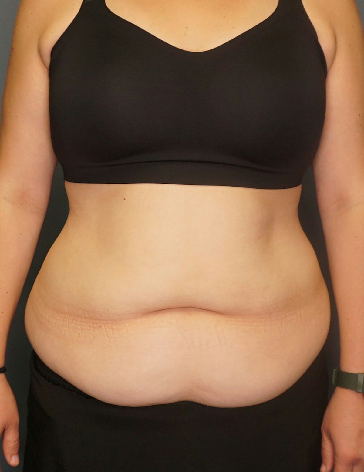 Tummy Tuck Before & After Gallery - Patient 212891 - Image 1