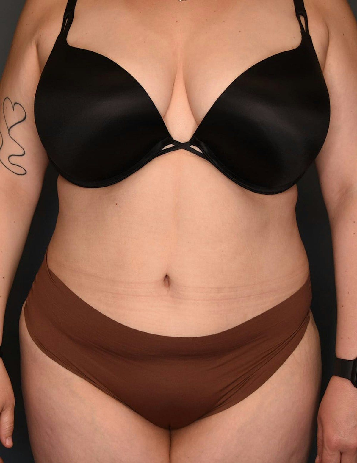 Tummy Tuck Before & After Gallery - Patient 212891 - Image 2
