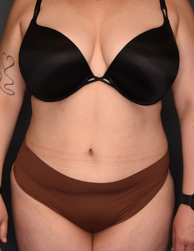 Tummy Tuck Before & After Gallery - Patient 212891 - Image 2