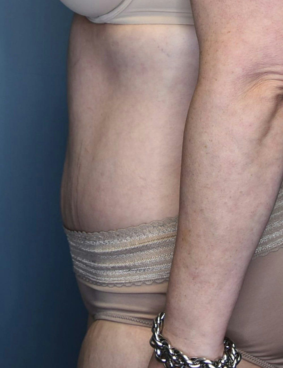 Tummy Tuck Before & After Gallery - Patient 420375 - Image 8