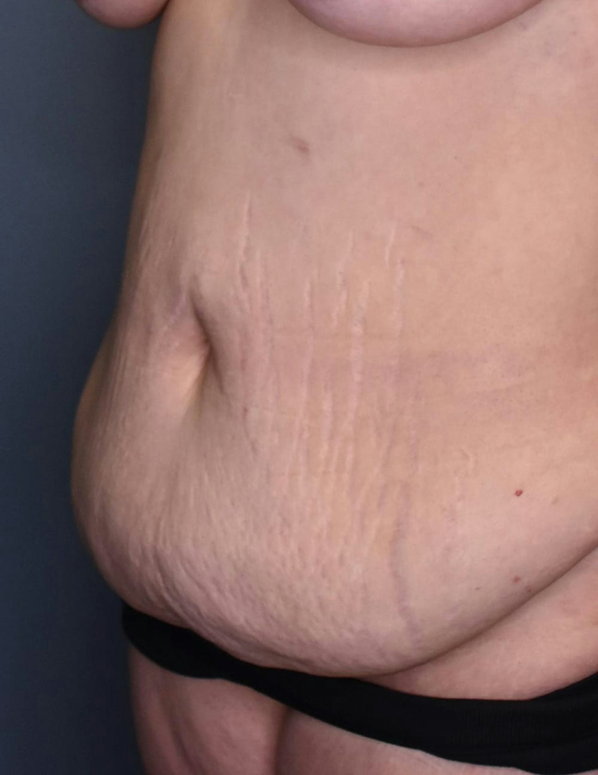 Tummy Tuck Before & After Gallery - Patient 420375 - Image 5
