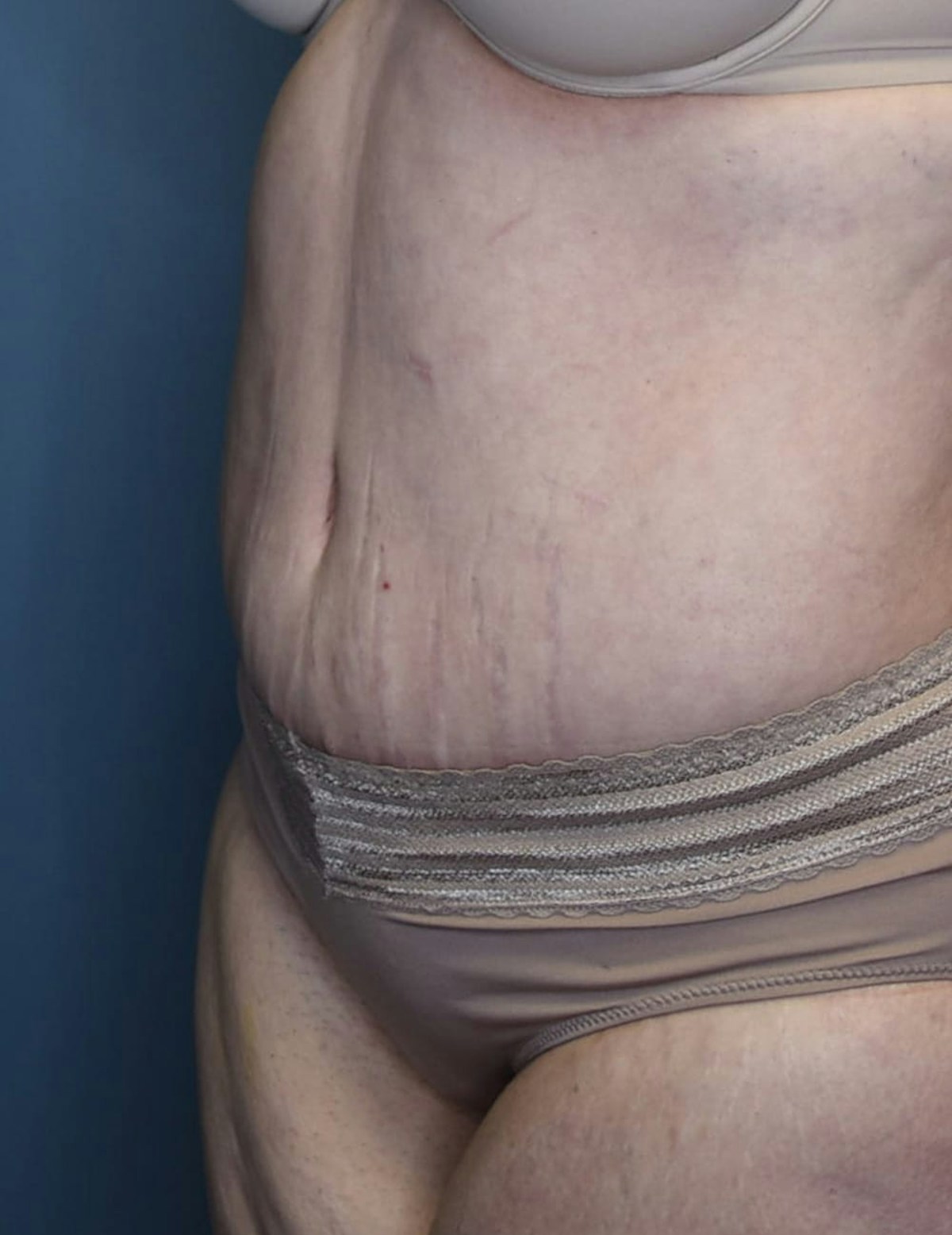 Tummy Tuck Before & After Gallery - Patient 420375 - Image 6