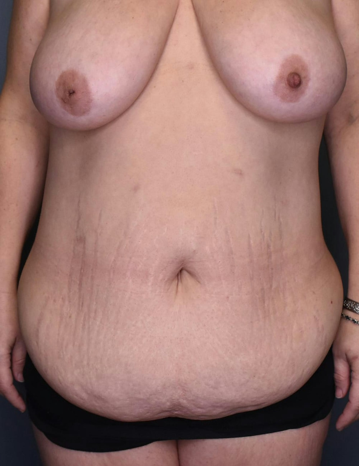 Tummy Tuck Before & After Gallery - Patient 420375 - Image 1