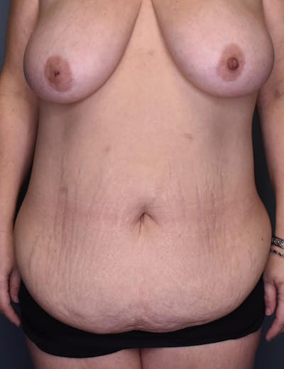 Tummy Tuck Before & After Gallery - Patient 420375 - Image 1