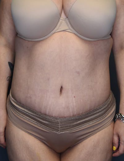Tummy Tuck Before & After Gallery - Patient 420375 - Image 2
