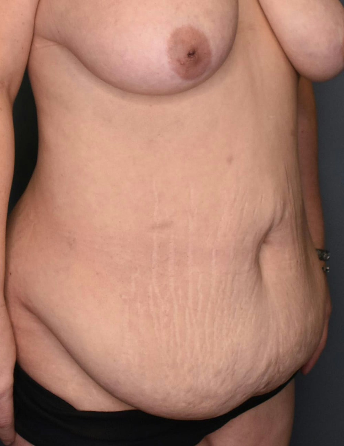 Tummy Tuck Before & After Gallery - Patient 420375 - Image 3