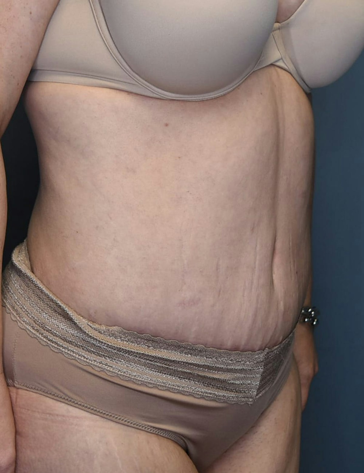 Tummy Tuck Before & After Gallery - Patient 420375 - Image 4