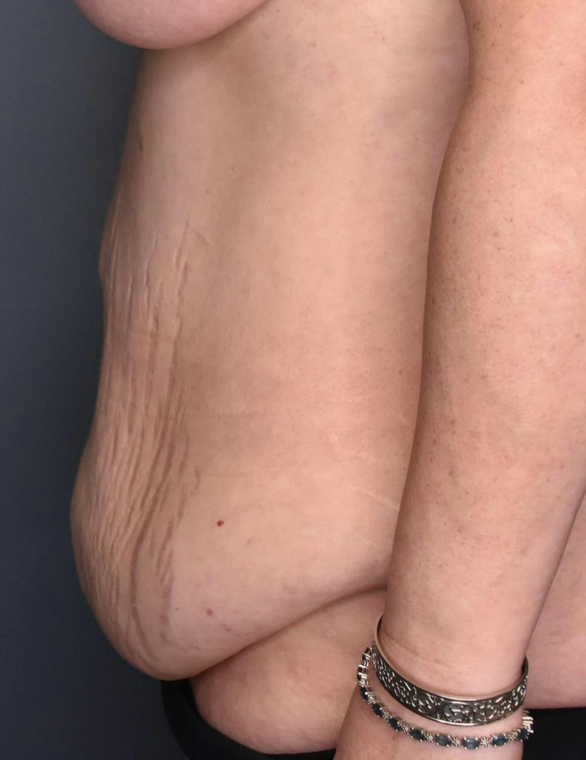 Tummy Tuck Before & After Gallery - Patient 420375 - Image 7