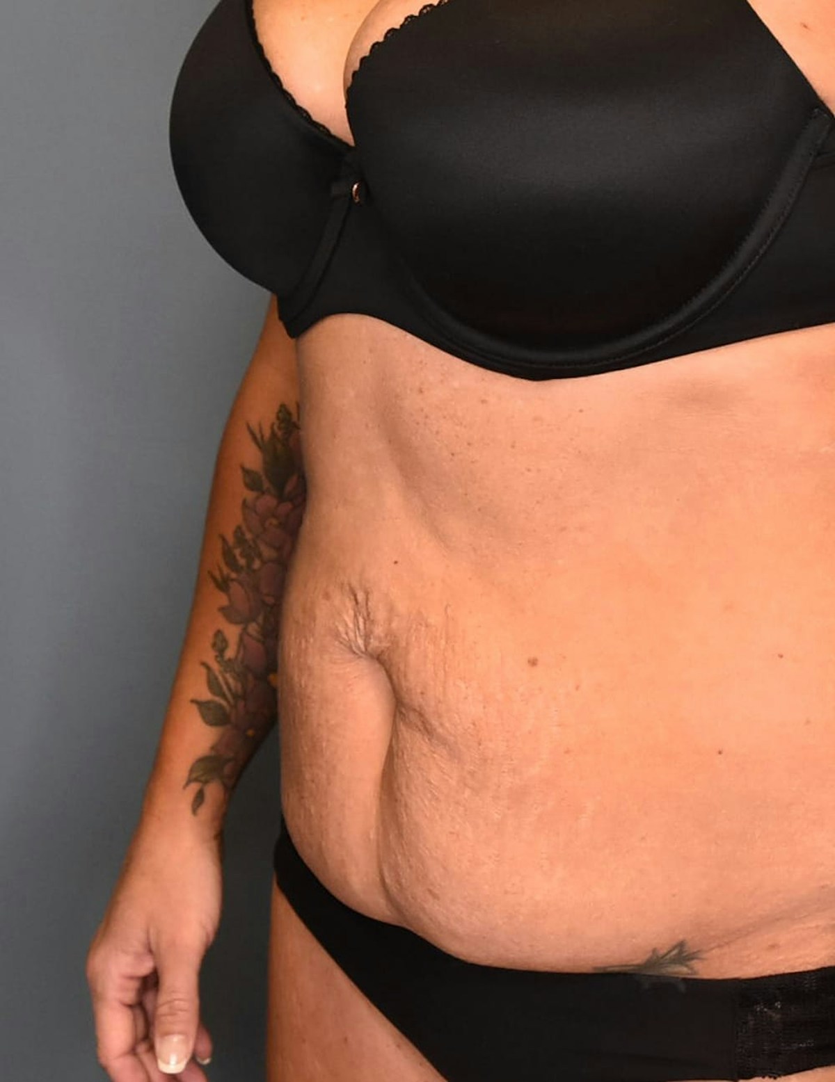 Tummy Tuck Before & After Gallery - Patient 421666 - Image 9