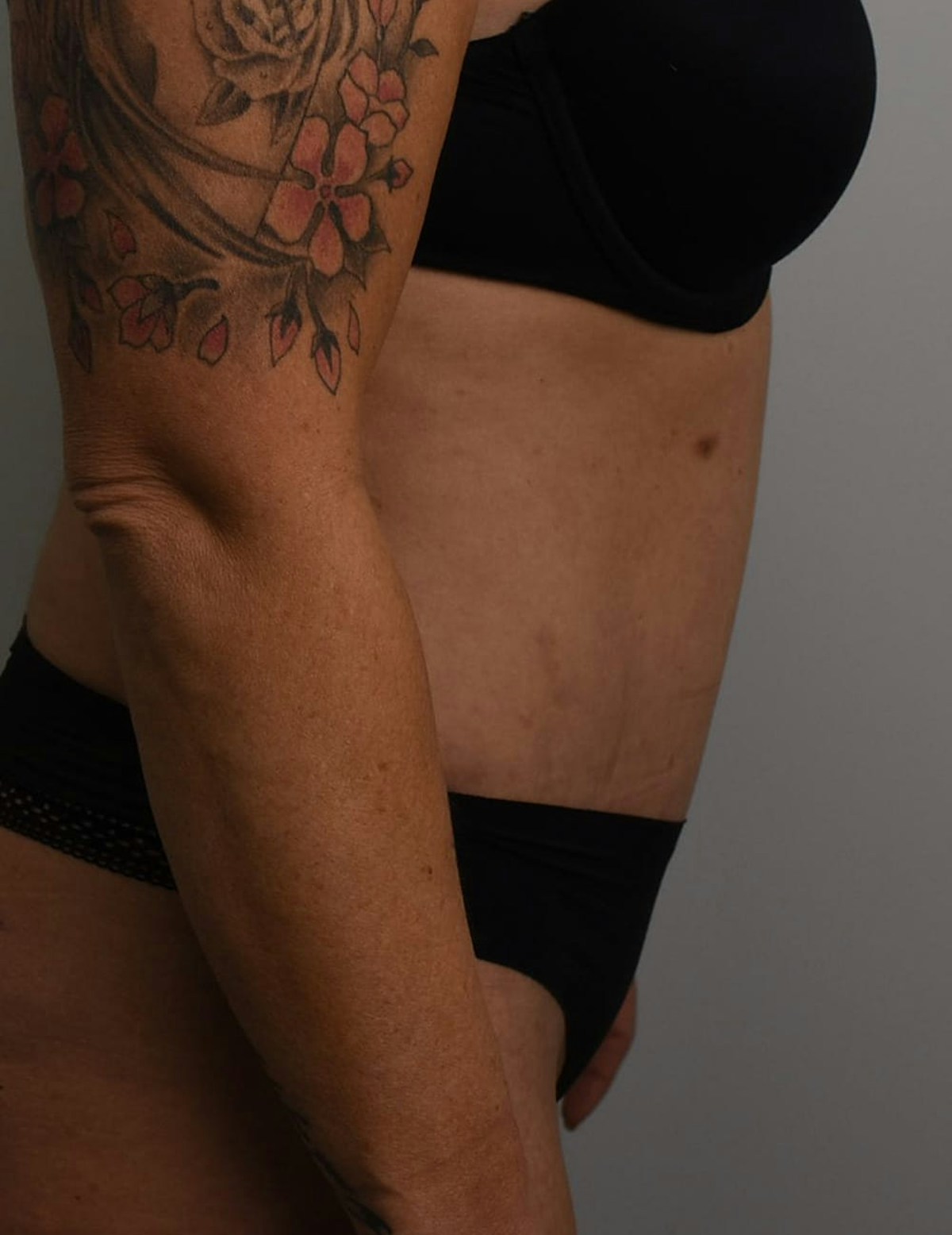 Tummy Tuck Before & After Gallery - Patient 421666 - Image 8