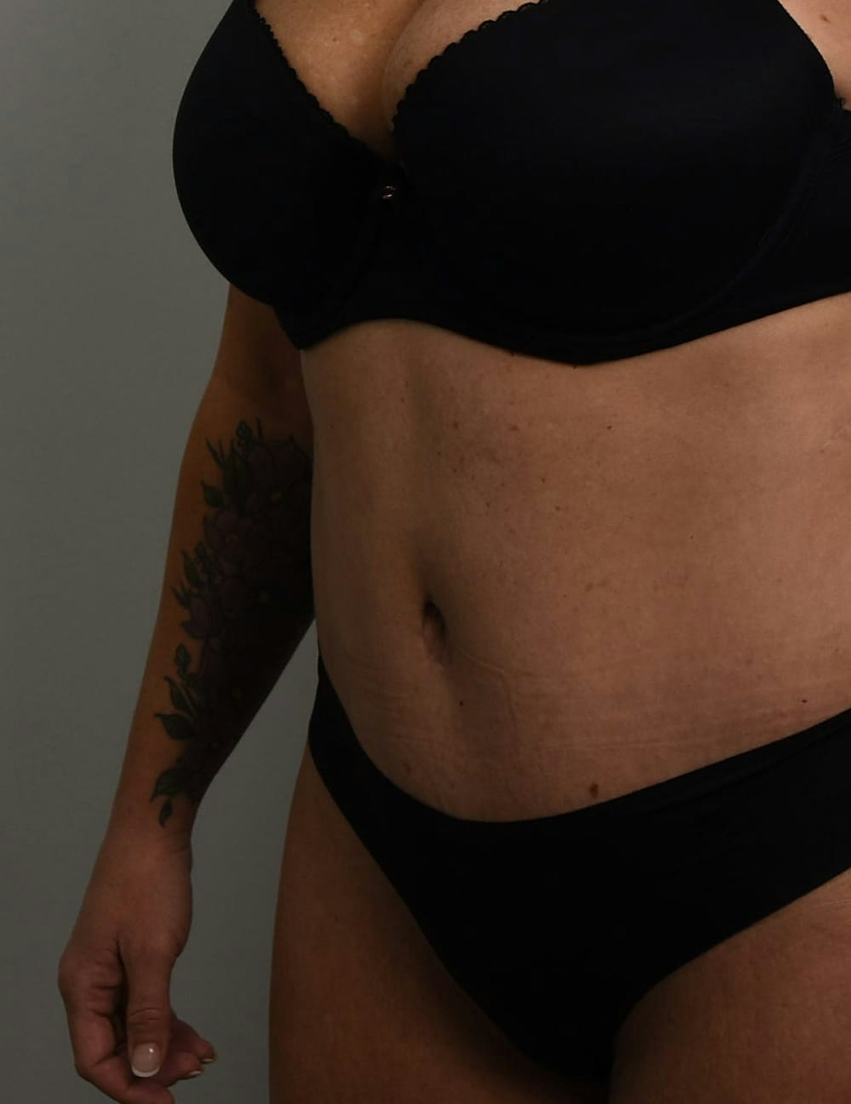Tummy Tuck Before & After Gallery - Patient 421666 - Image 10