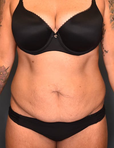Tummy Tuck Before & After Gallery - Patient 421666 - Image 1