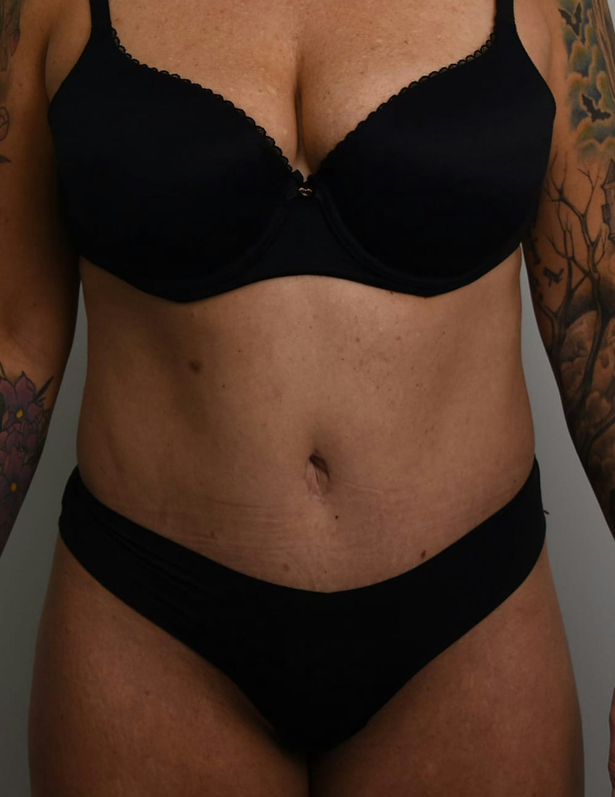 Tummy Tuck Before & After Gallery - Patient 421666 - Image 2