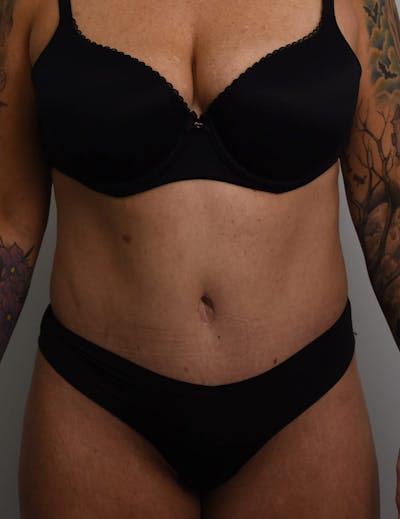 Tummy Tuck Before & After Gallery - Patient 421666 - Image 2