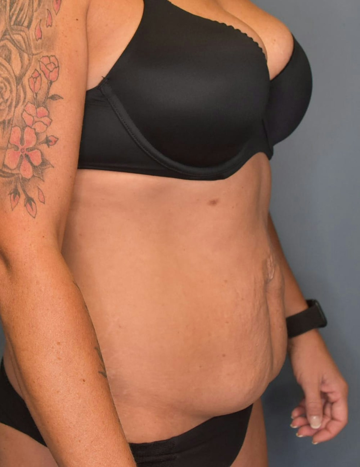Tummy Tuck Before & After Gallery - Patient 421666 - Image 5