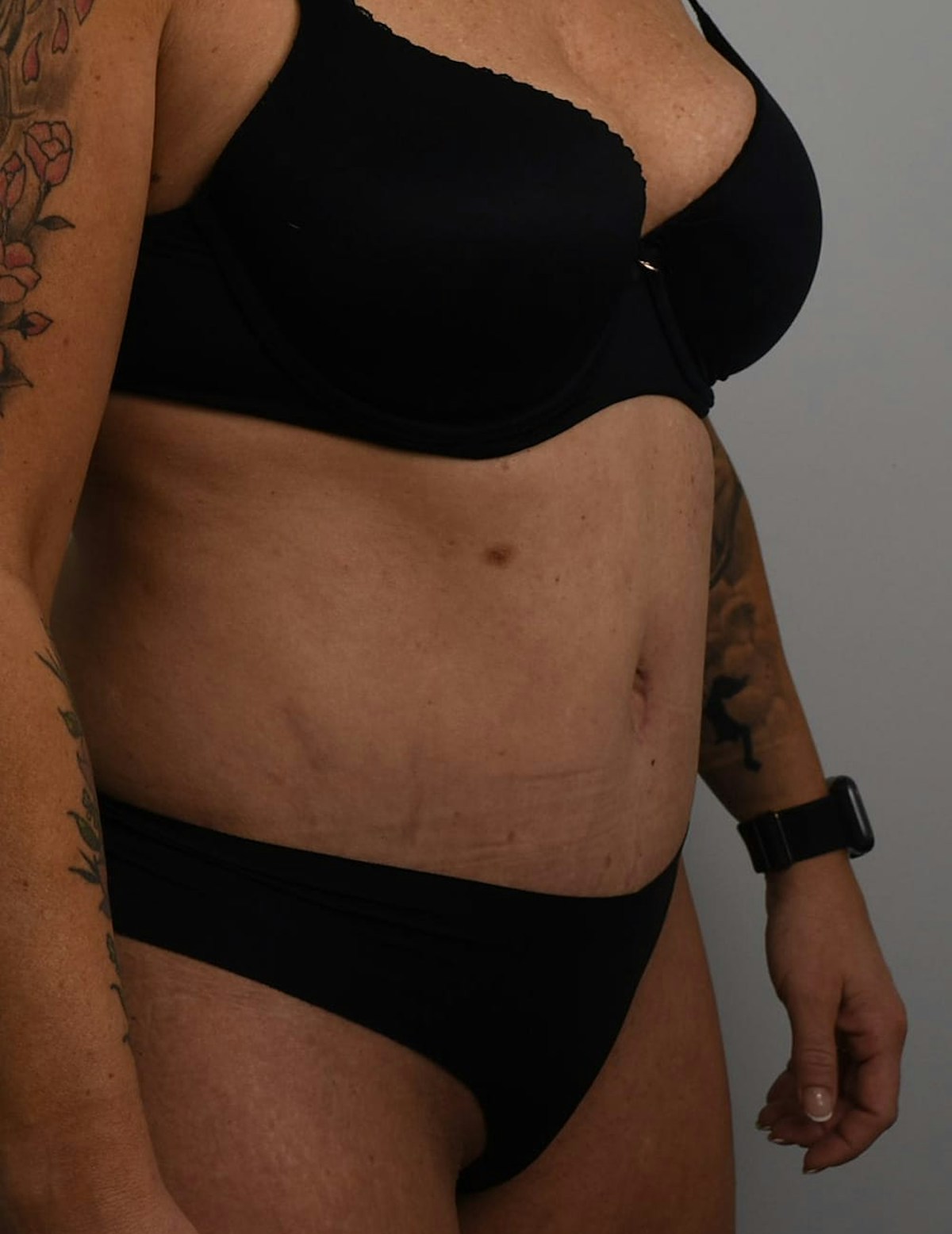 Tummy Tuck Before & After Gallery - Patient 421666 - Image 6