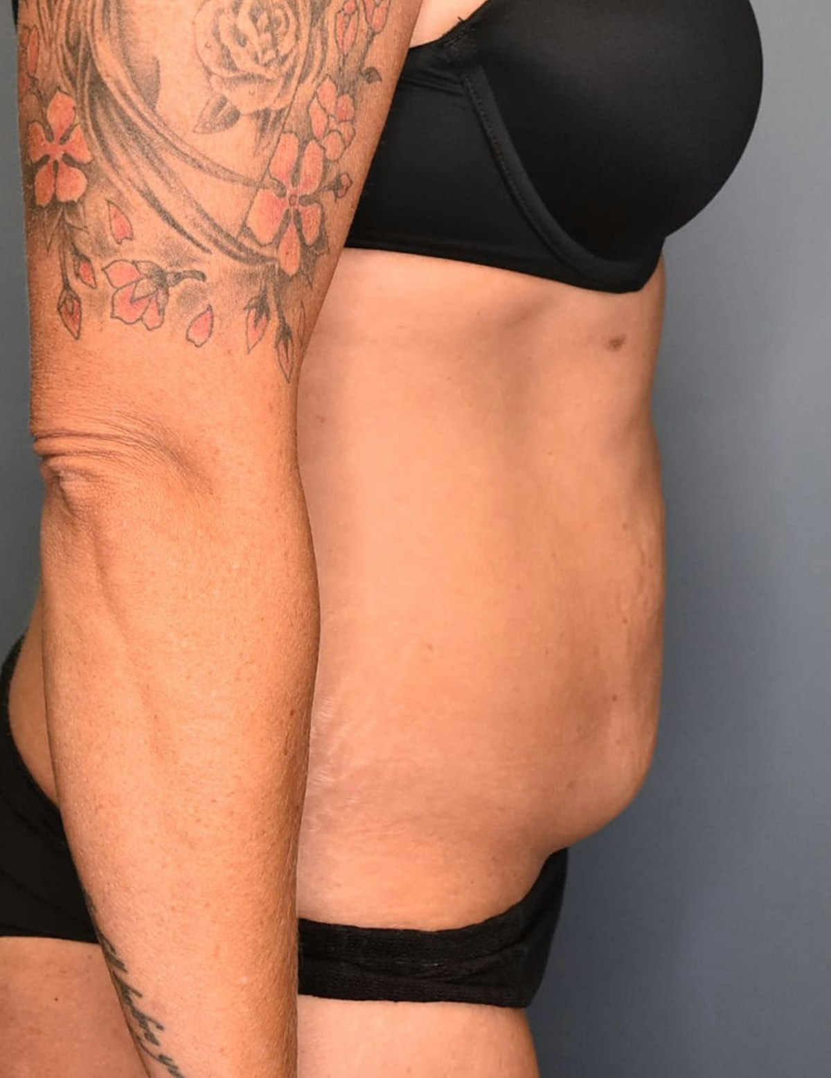 Tummy Tuck Before & After Gallery - Patient 421666 - Image 7