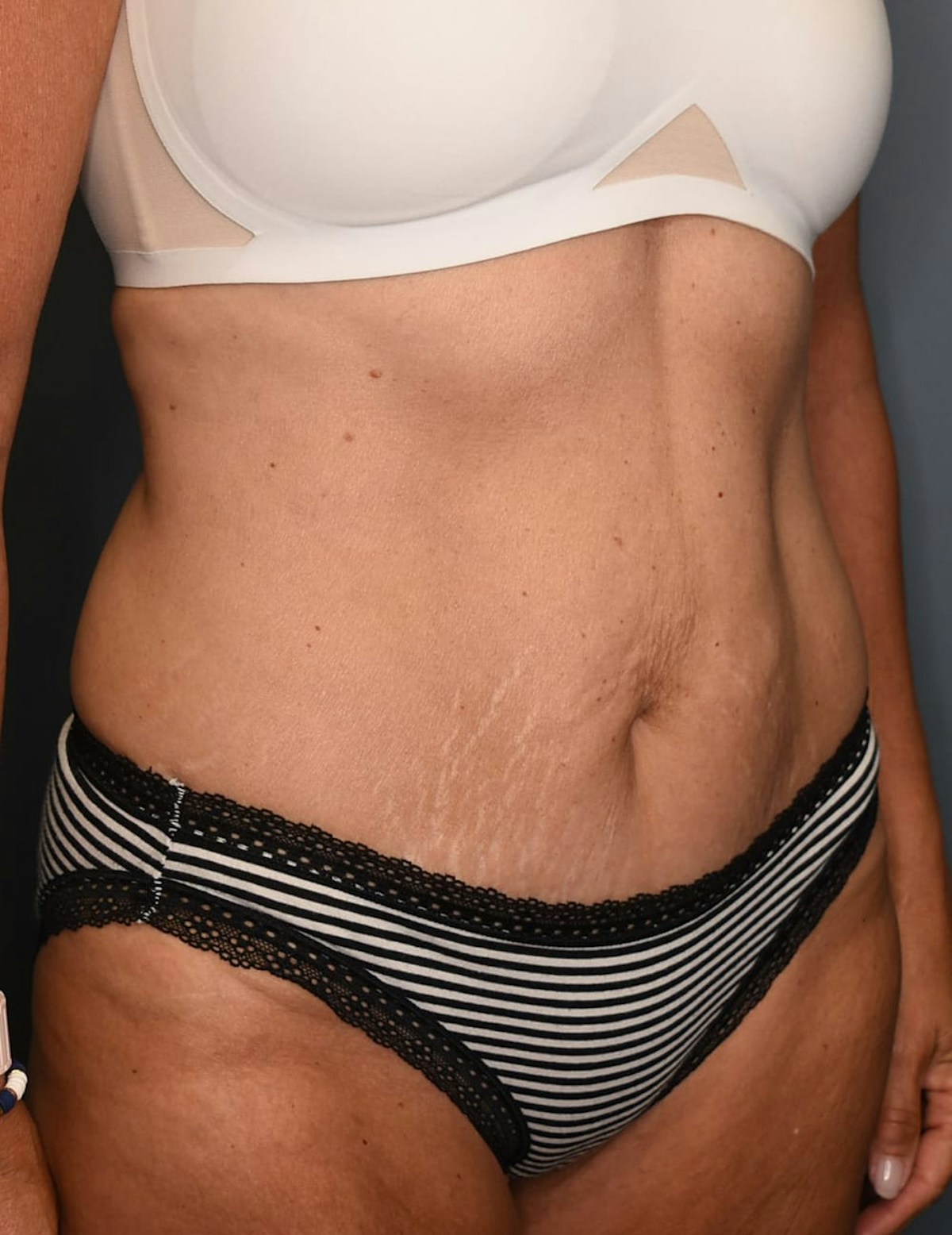 Tummy Tuck Before & After Gallery - Patient 251469 - Image 4