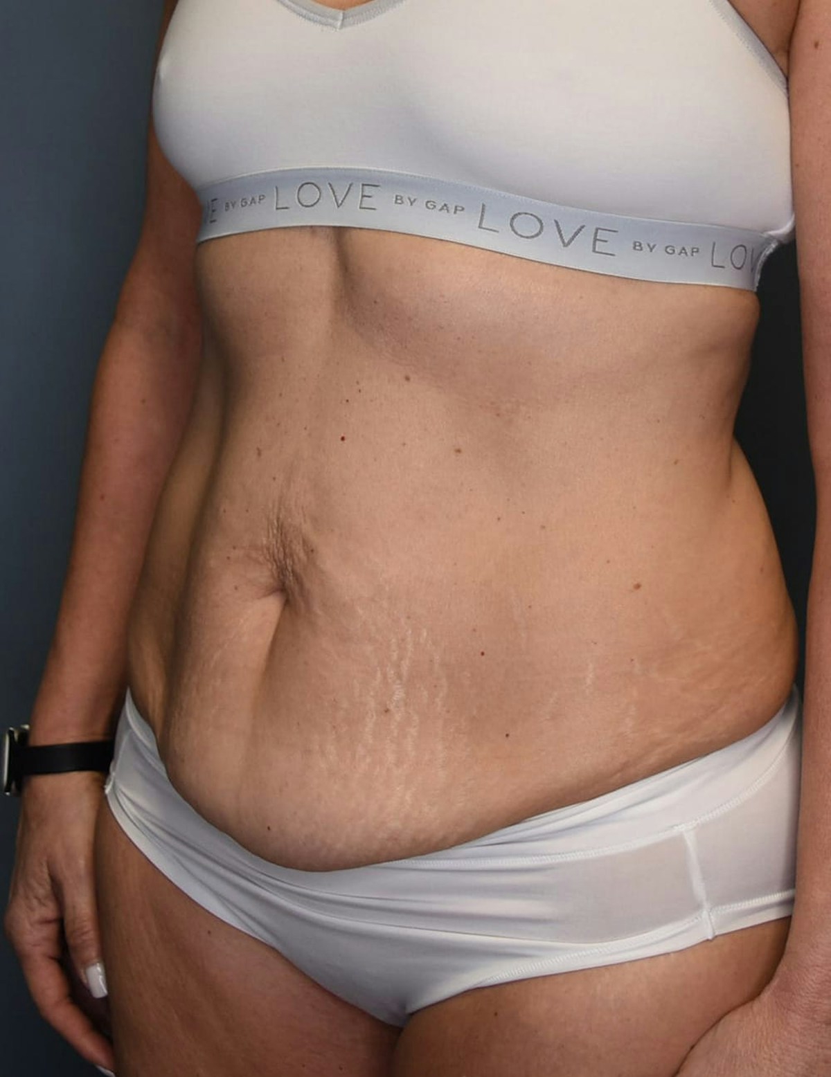 Tummy Tuck Before & After Gallery - Patient 251469 - Image 7