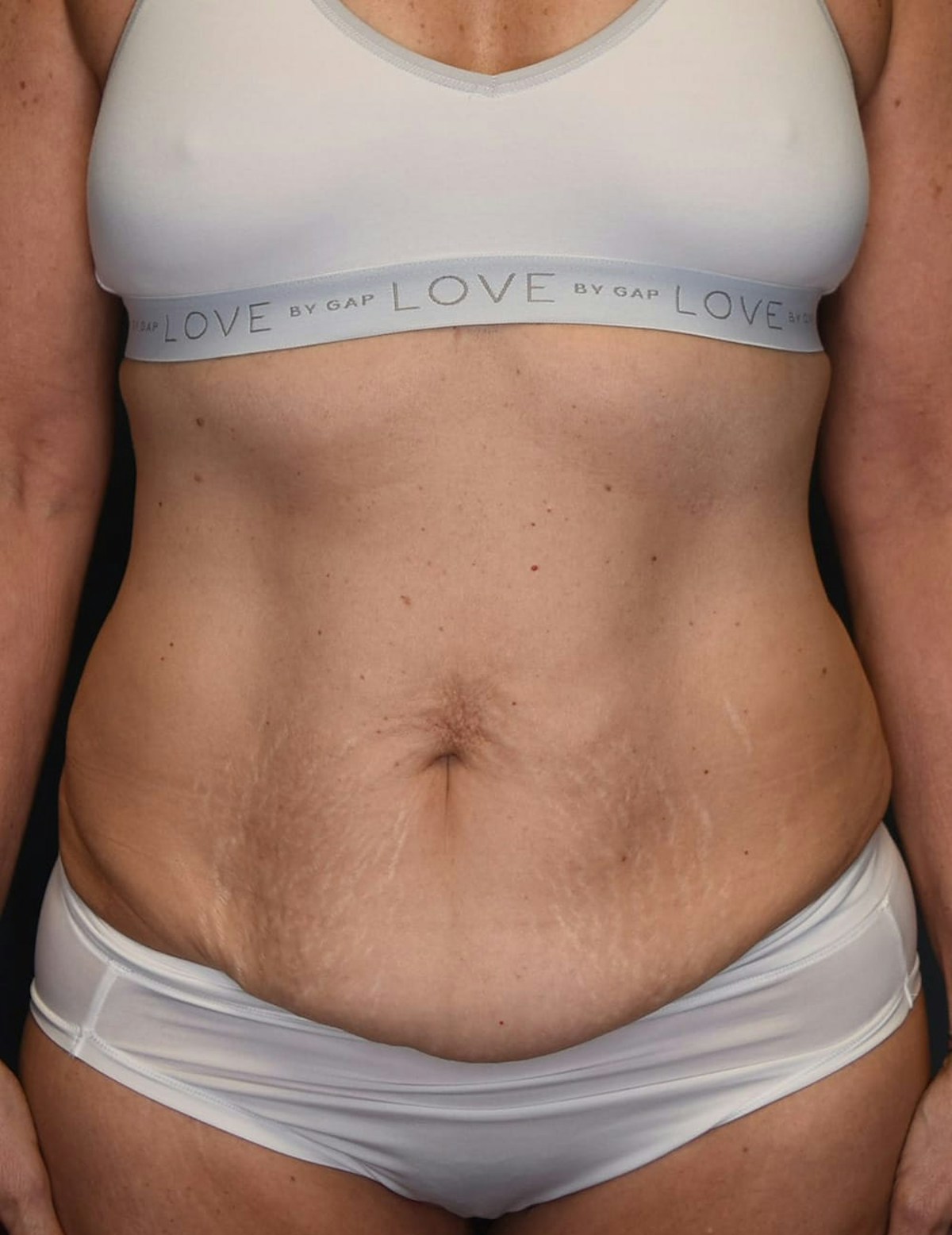 Tummy Tuck Before & After Gallery - Patient 251469 - Image 1