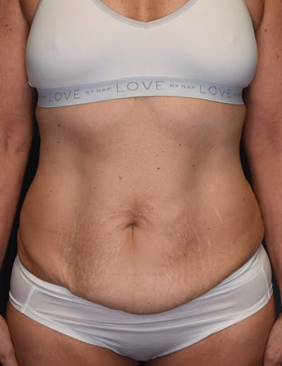 Tummy Tuck Before & After Gallery - Patient 251469 - Image 1