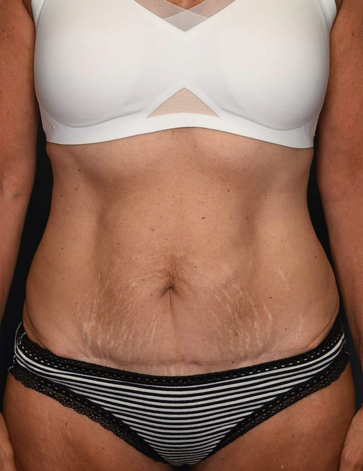 Tummy Tuck Before & After Gallery - Patient 251469 - Image 2