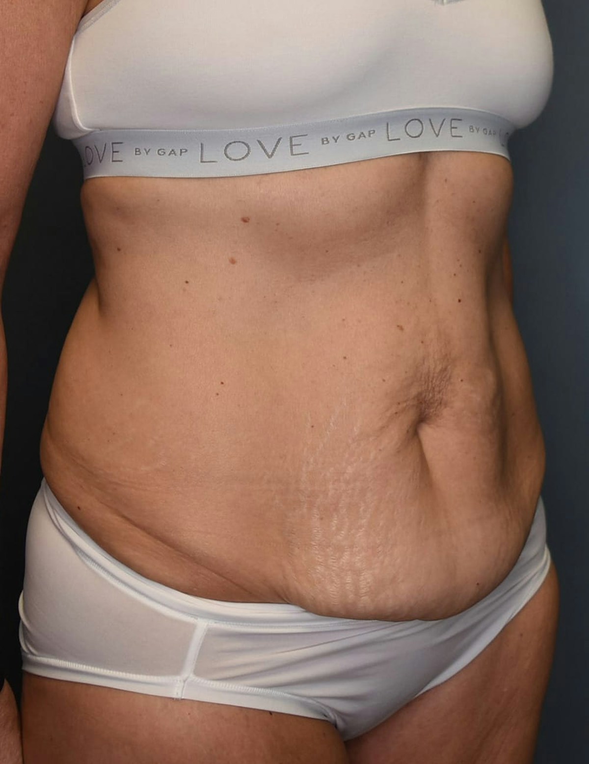 Tummy Tuck Before & After Gallery - Patient 251469 - Image 3