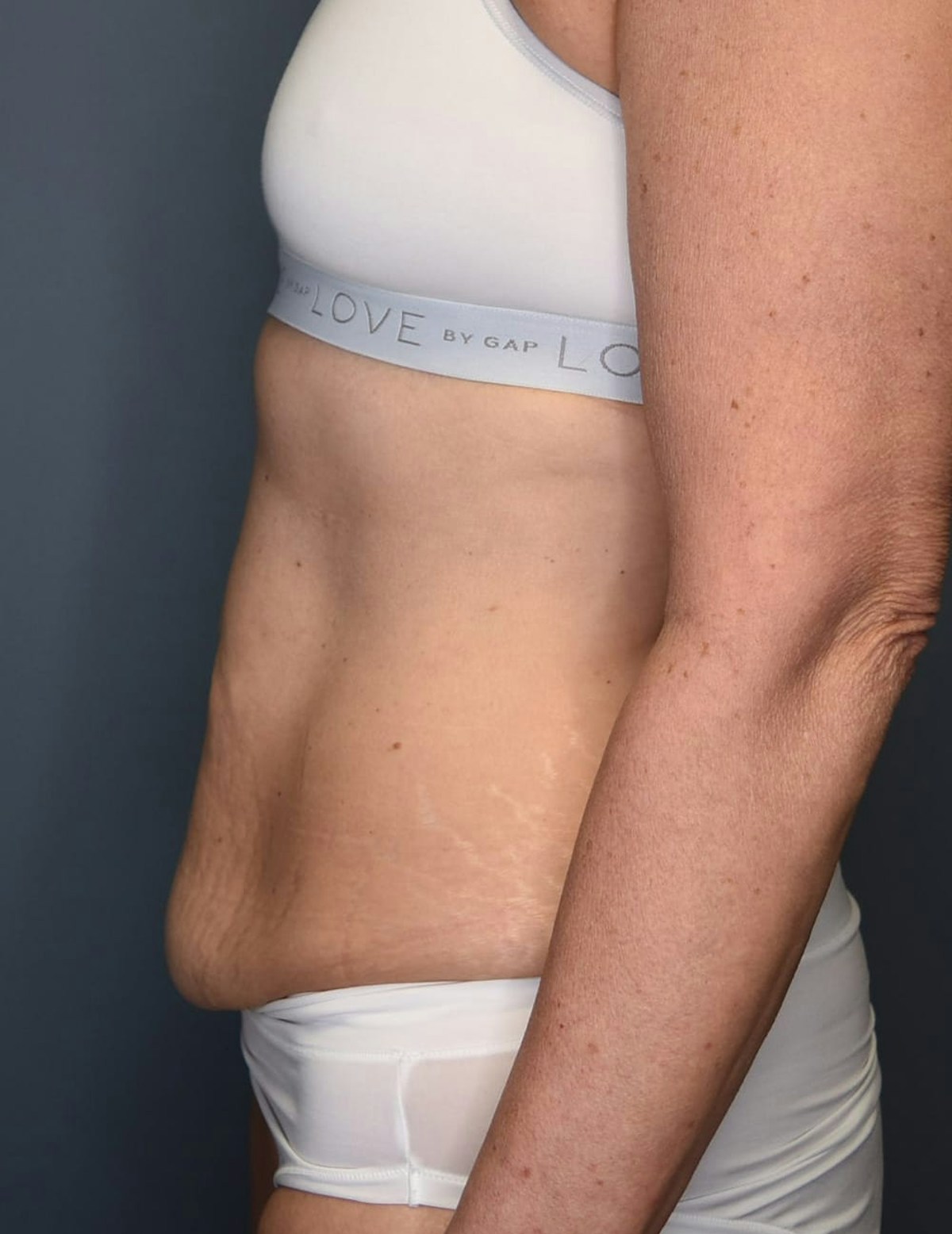 Tummy Tuck Before & After Gallery - Patient 251469 - Image 9