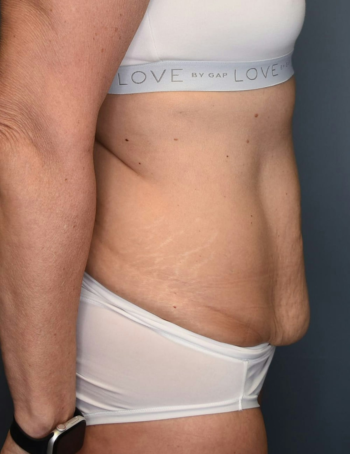 Tummy Tuck Before & After Gallery - Patient 251469 - Image 5