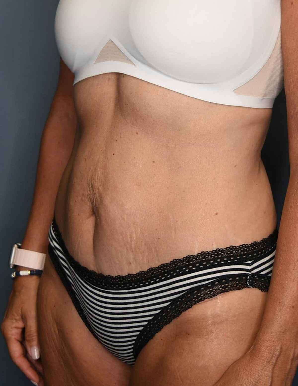 Tummy Tuck Before & After Gallery - Patient 251469 - Image 8