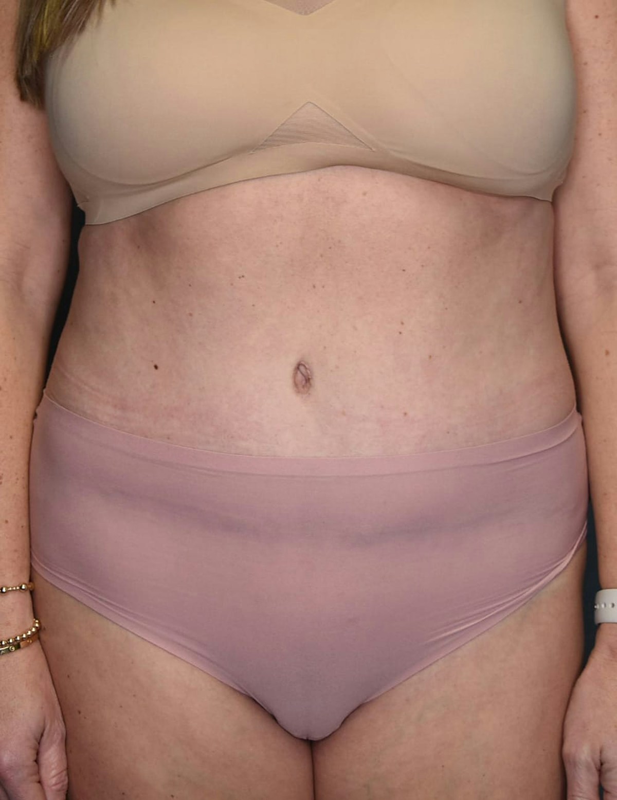 Tummy Tuck Before & After Gallery - Patient 869524 - Image 2