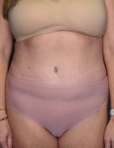 Tummy Tuck Before & After Gallery - Patient 869524 - Image 2