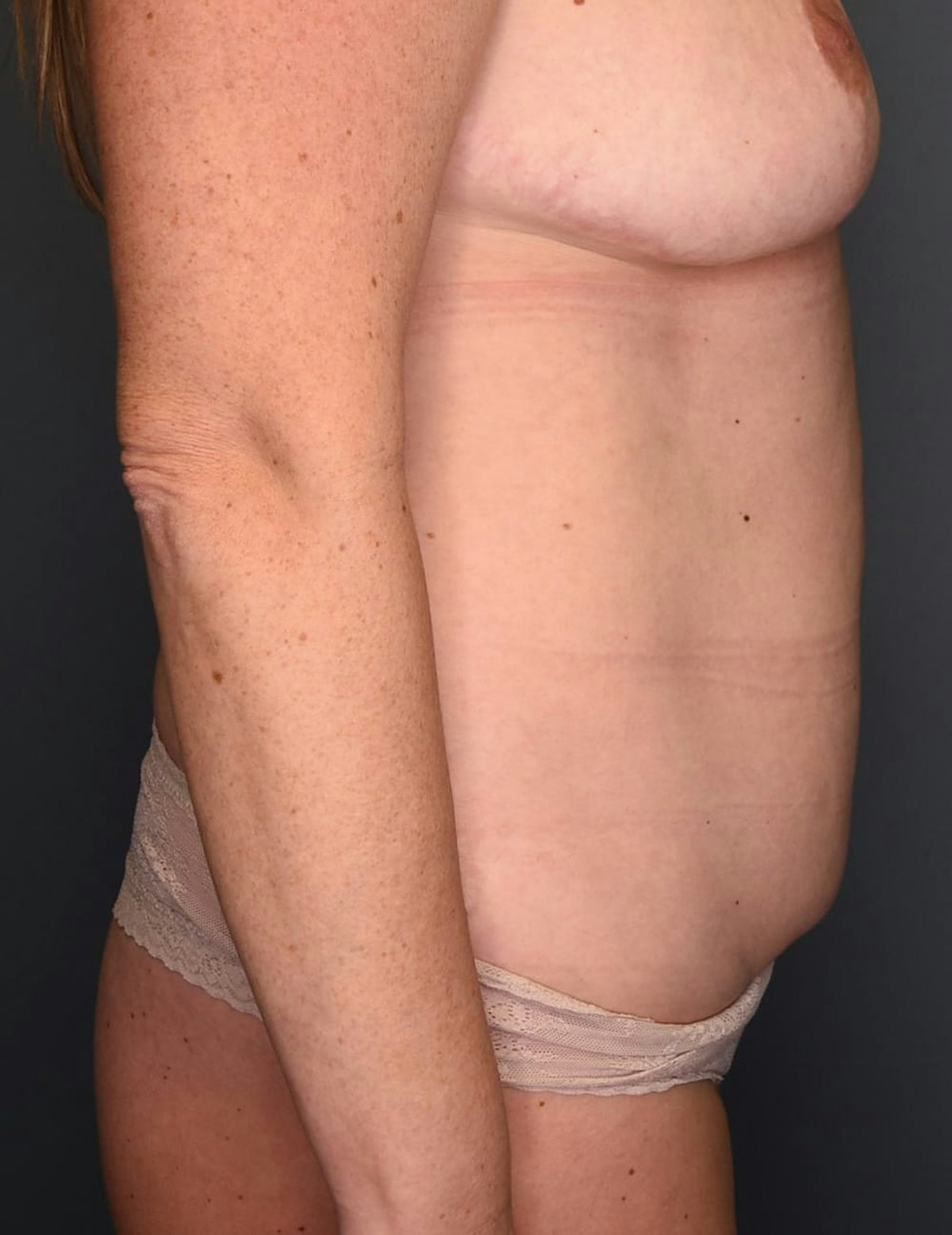 Tummy Tuck Before & After Gallery - Patient 869524 - Image 3