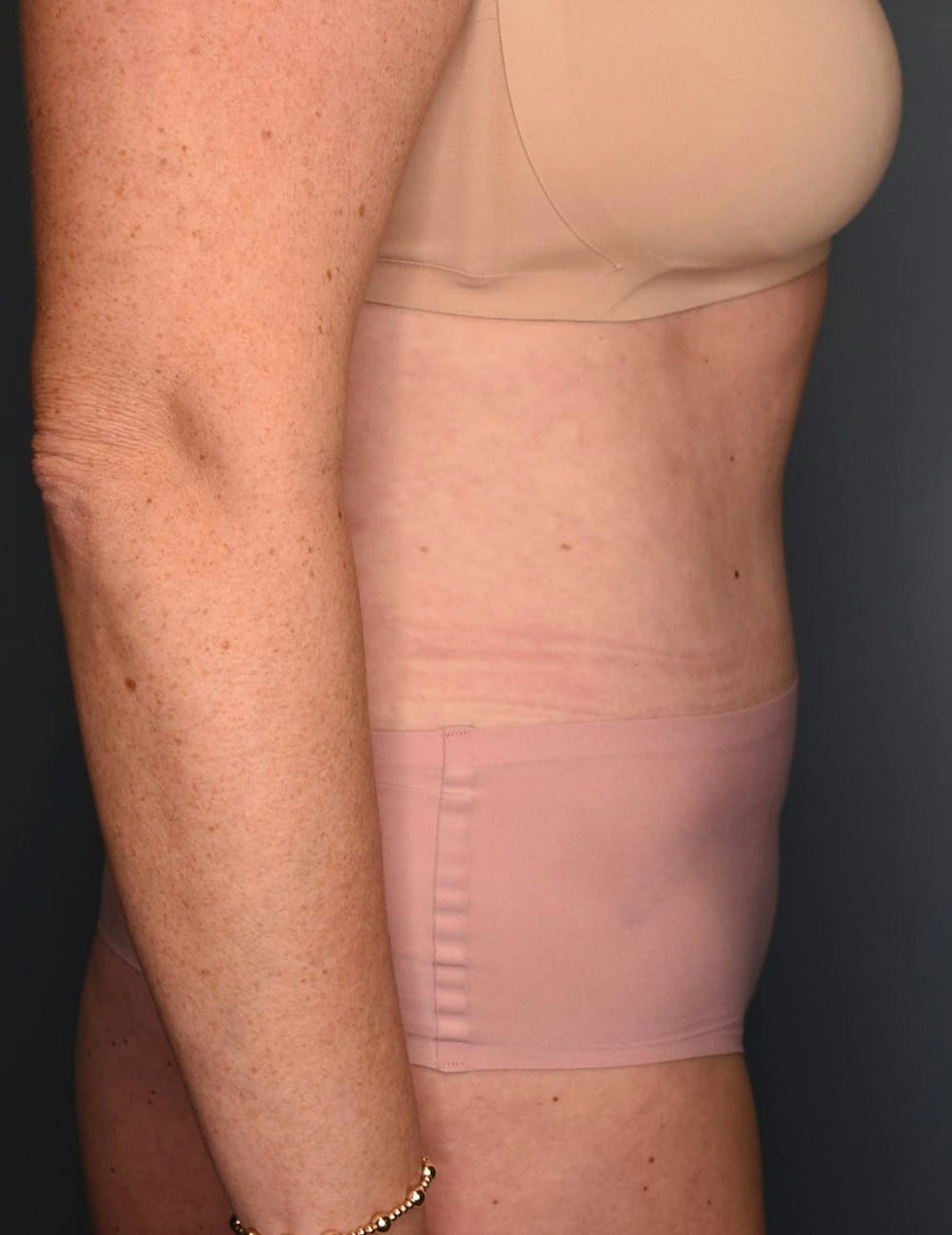 Tummy Tuck Before & After Gallery - Patient 869524 - Image 4