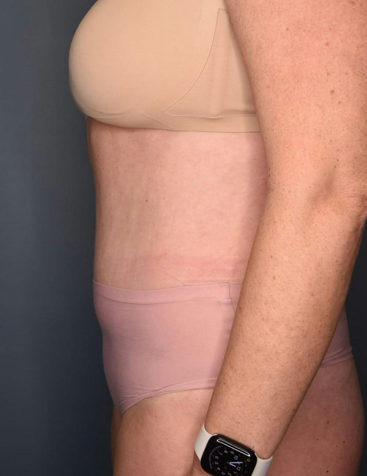 Tummy Tuck Before & After Gallery - Patient 869524 - Image 6