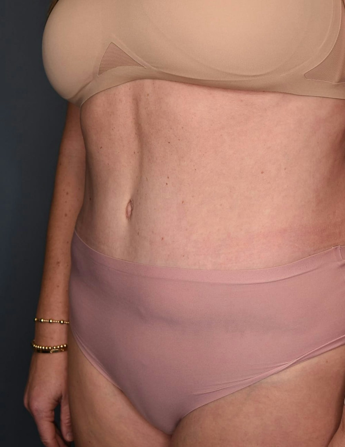 Tummy Tuck Before & After Gallery - Patient 869524 - Image 8