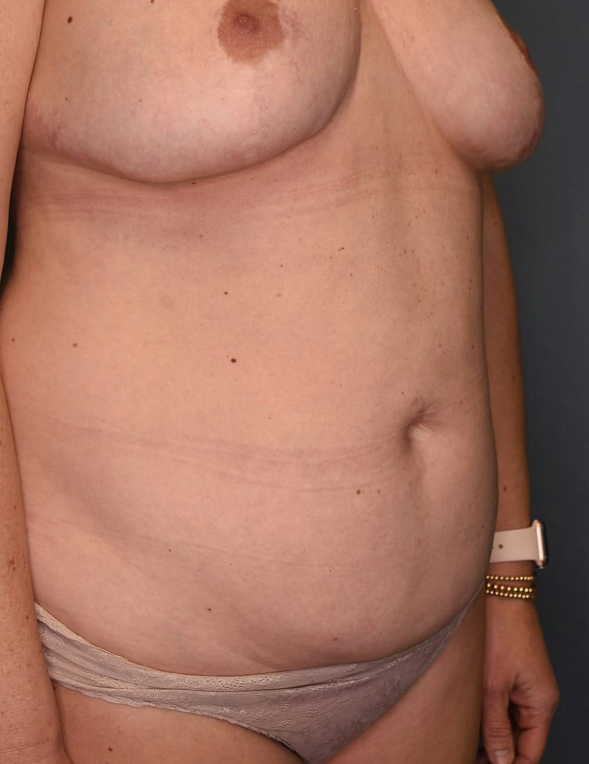 Tummy Tuck Before & After Gallery - Patient 869524 - Image 9