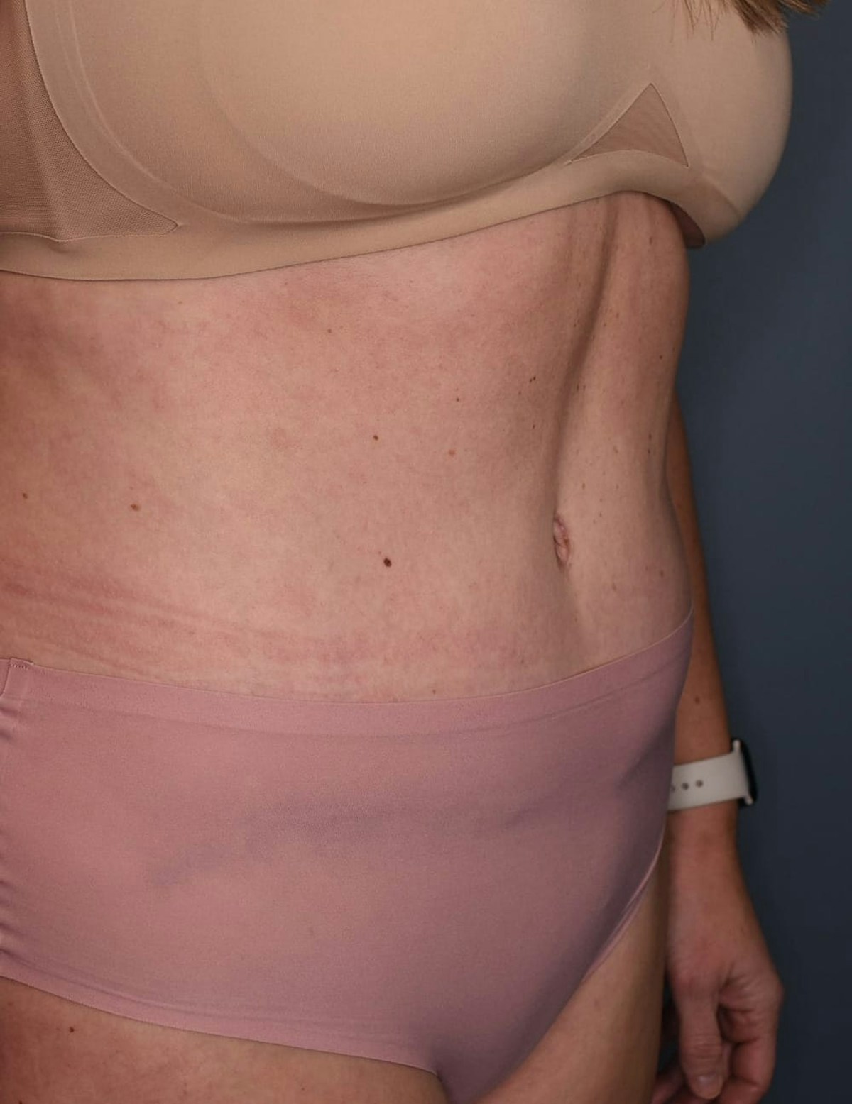 Tummy Tuck Before & After Gallery - Patient 869524 - Image 10