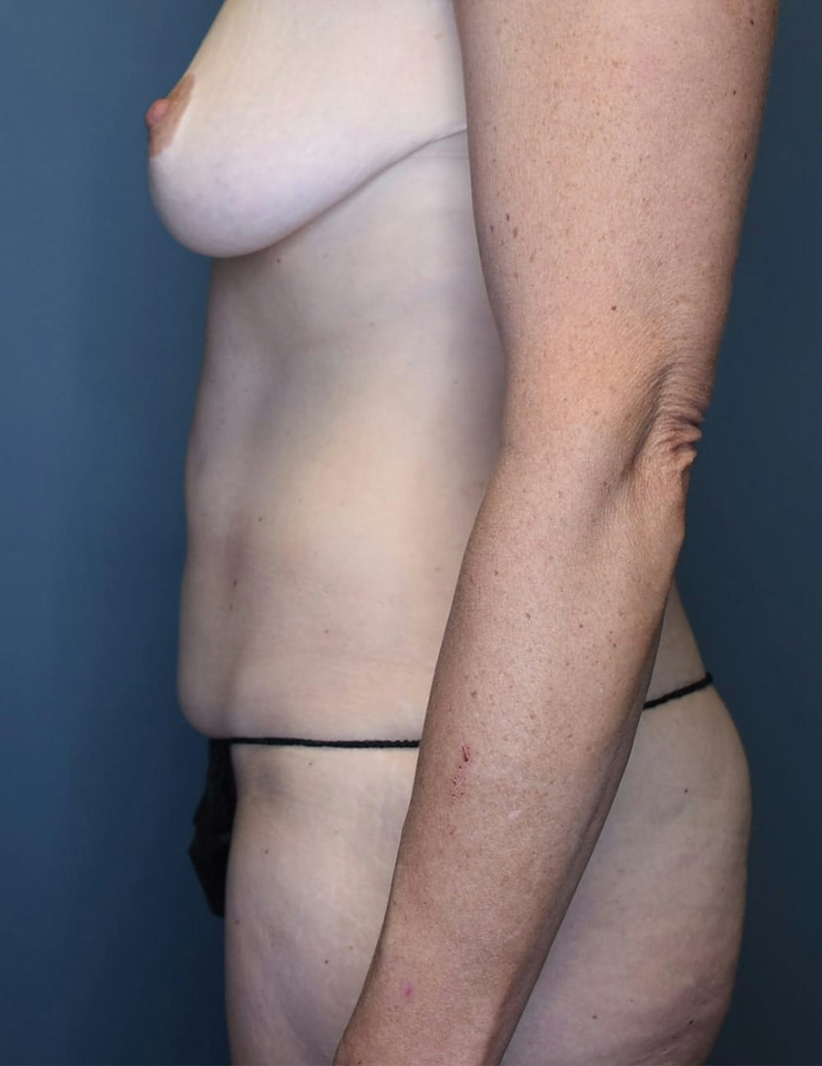 Tummy Tuck Before & After Gallery - Patient 286473 - Image 5