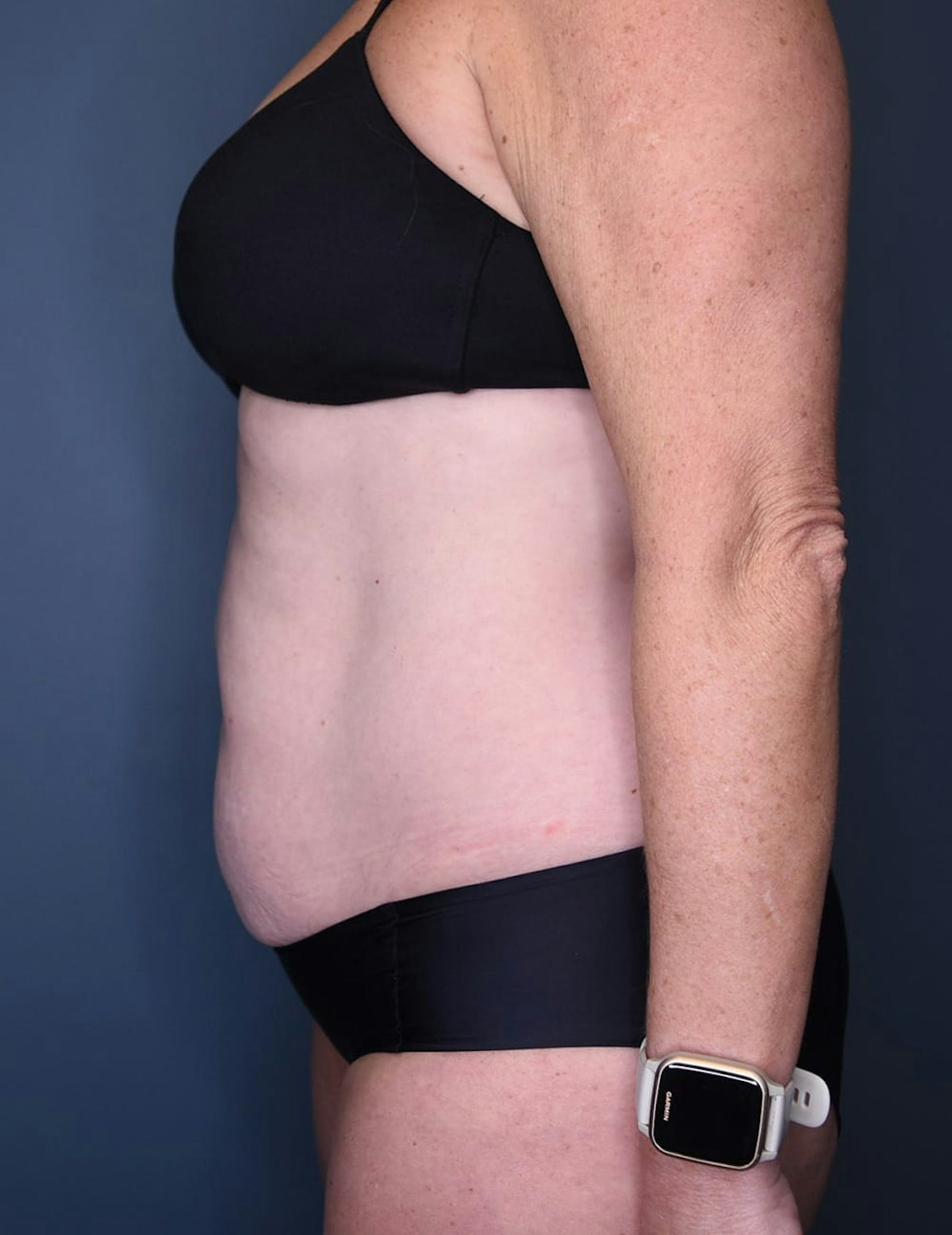 Tummy Tuck Before & After Gallery - Patient 182561 - Image 5
