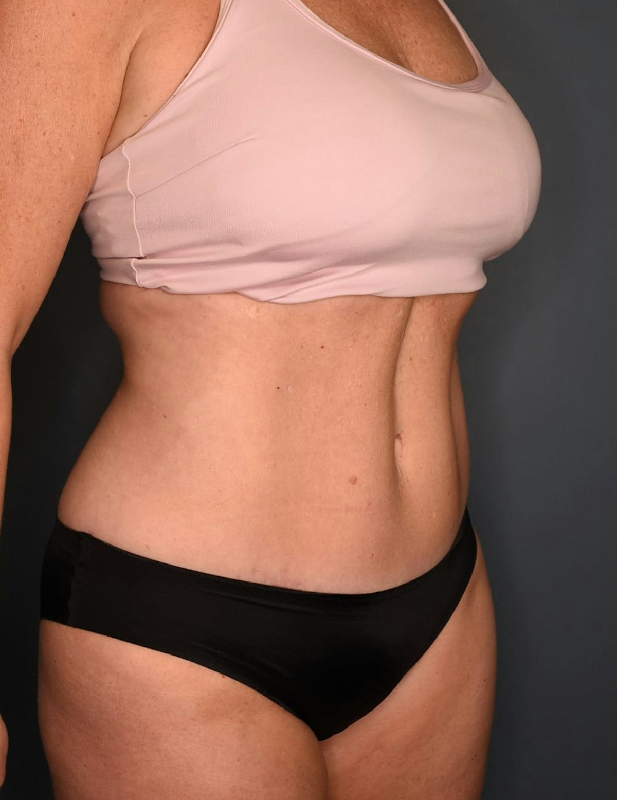 Tummy Tuck Before & After Gallery - Patient 182561 - Image 4