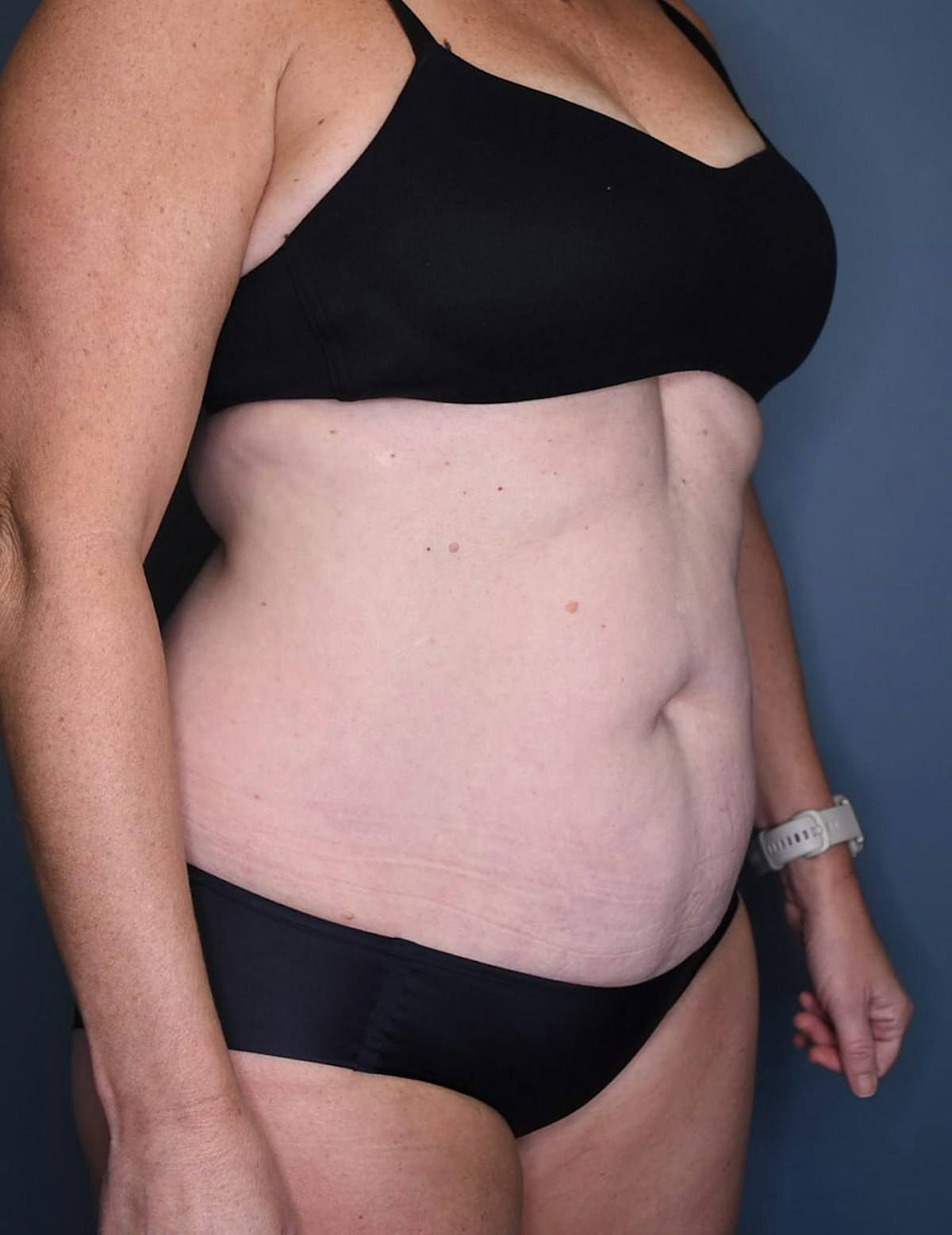 Tummy Tuck Before & After Gallery - Patient 182561 - Image 3