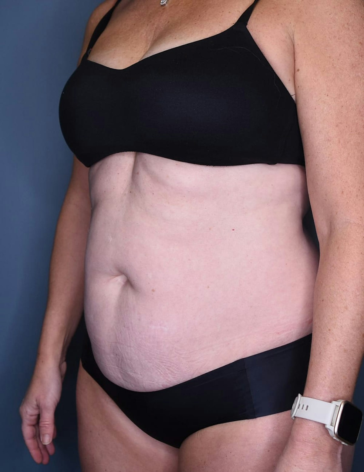 Tummy Tuck Before & After Gallery - Patient 182561 - Image 7