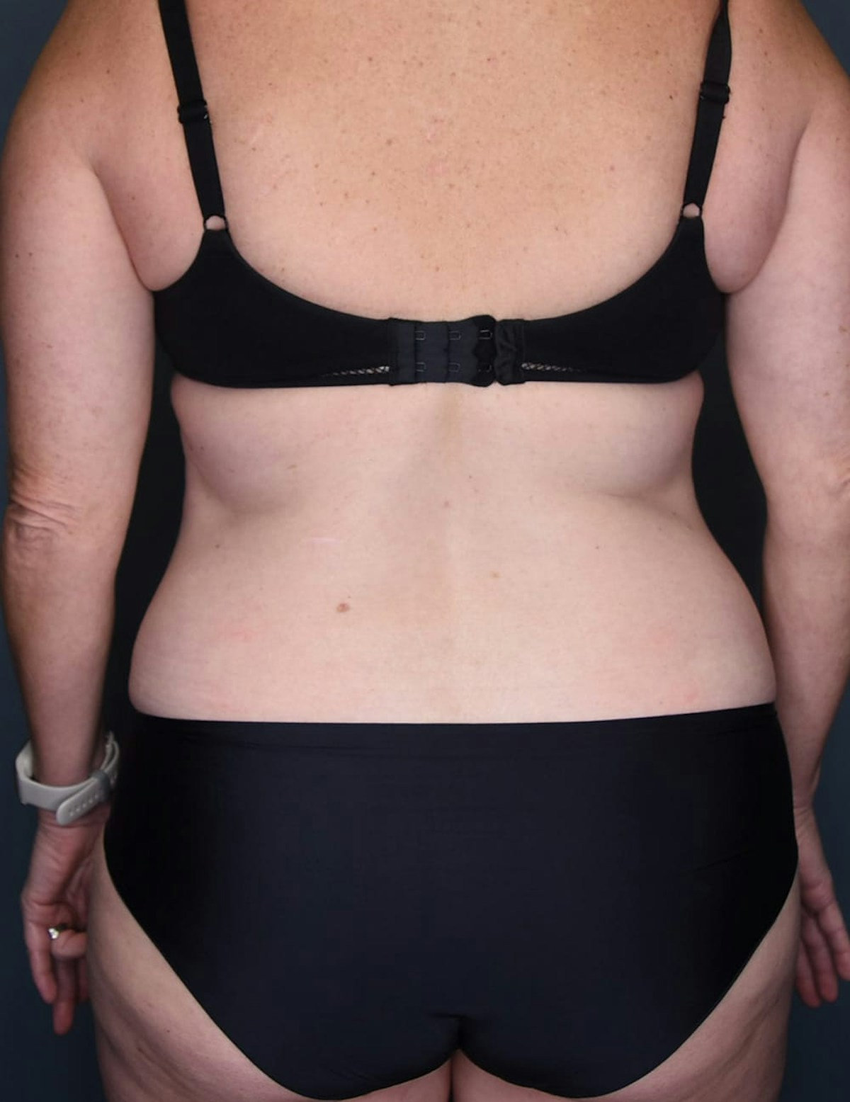 Tummy Tuck Before & After Gallery - Patient 182561 - Image 9