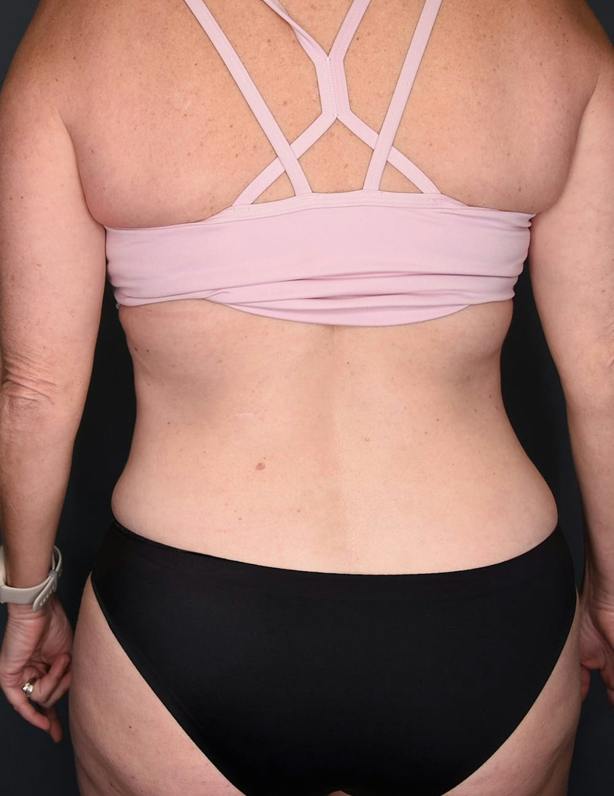 Tummy Tuck Before & After Gallery - Patient 182561 - Image 10