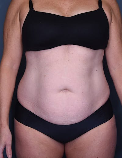 Tummy Tuck Before & After Gallery - Patient 182561 - Image 1